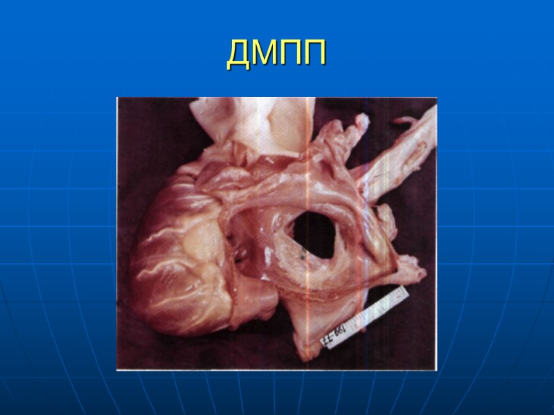 ДМПП